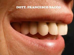 Implantologia Dentale Dr. Francesco Sacco