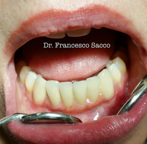 Implantologia Dentale Dr. Francesco Sacco Studio Dentistico Sacco Estetica Dentale implantologia avellino