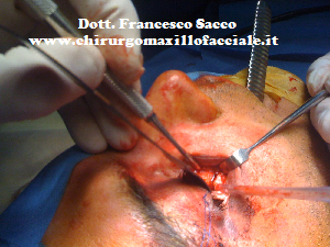 Chirurgia Maxillo Facciale Dr.Sacco Salerno Avellino Napoli