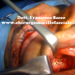 osteosintesi pilastro zigomatico