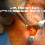 Osteosintesi