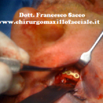 osteosintesi pavimento dell’orbita
