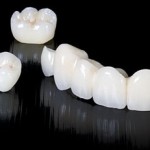 zirconia_corona_e_ponte