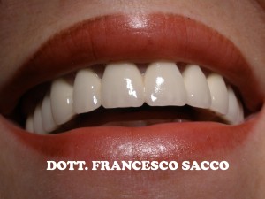 Studio Dentistico Sacco Estetica Dentale FACCETTE DENTALI SALERNO AVELLINO POTENZA DR.SACCO