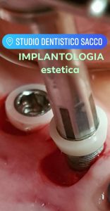 Implantologia Carico Immediato DR.SACCO Salerno Avellino Padula