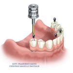 all-on-4-dental-implants[1]