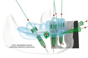 Implantologia Prezzi Salerno
