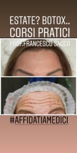 botox dr. francesco Centri Dentistici Dr.Francesco Sacco Chirurgo Maxillo Facciale Estetica