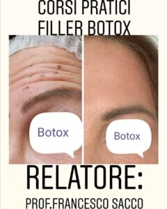 Medicina Estetica Campania - DR.FRANCESCO SACCO botox